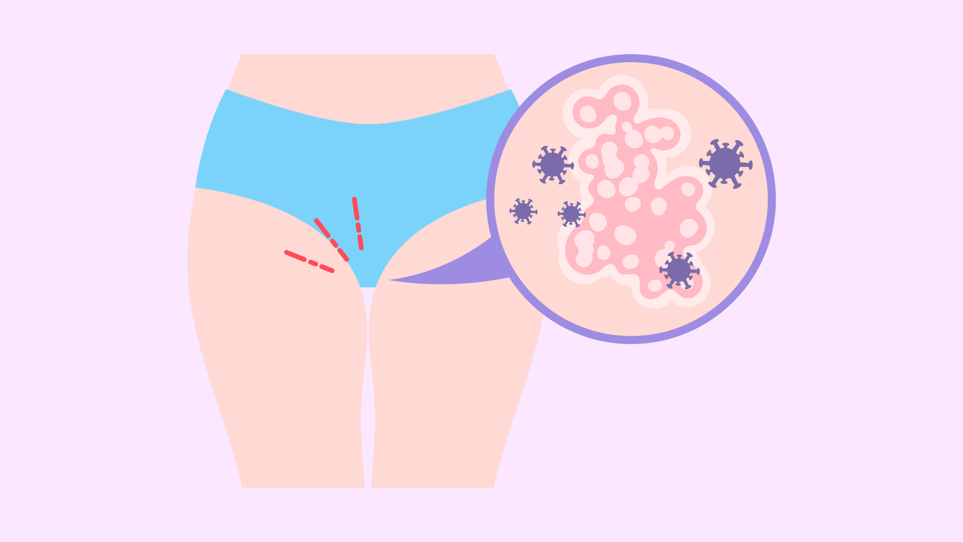 vaginal infection illustration